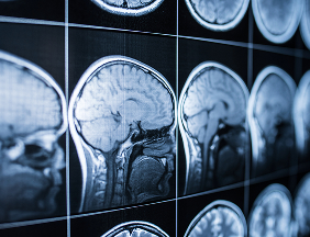 brain MRI