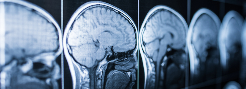 brain injury scan