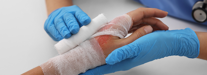 burn injury